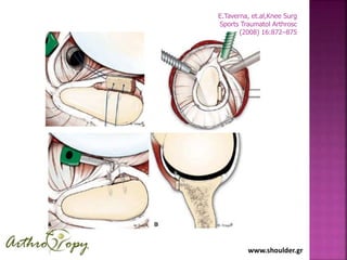 www.shoulder.gr
E.Taverna, et.al,Knee Surg
Sports Traumatol Arthrosc
(2008) 16:872–875
 