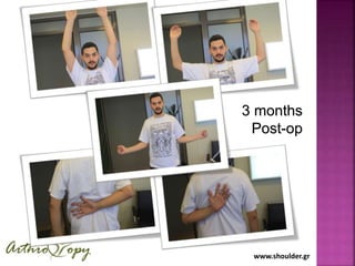 www.shoulder.gr
3 months
Post-op
 