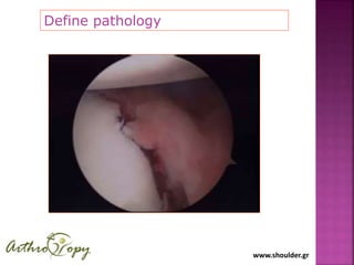 www.shoulder.gr
Define pathology
 