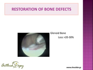 www.shoulder.gr
Glenoid Bone
Loss >20-30%
 