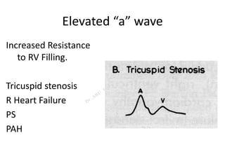 Elevated “a” wave
Increased Resistance
to RV Filling.
Tricuspid stenosis
R Heart Failure
PS
PAH
 