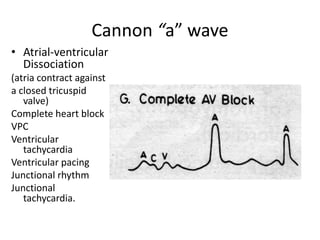 Cannon “a” wave
• Atrial-ventricular
Dissociation
(atria contract against
a closed tricuspid
valve)
Complete heart block
VPC
Ventricular
tachycardia
Ventricular pacing
Junctional rhythm
Junctional
tachycardia.
 