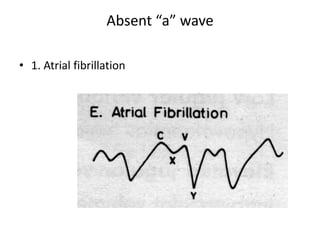 Absent “a” wave
• 1. Atrial fibrillation
 
