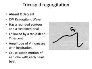 Tricuspid regurgitation
• Absent X Decsent
• CV/ Regurgitant Wave
• Has a rounded contour
and a sustained peak
• Followed by a rapid deep
Y descent
• Amplitude of V increases
with inspiration.
• Cause subtle motion of
ear lobe with each heart
beat
 