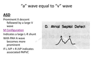 “a” wave equal to “v” wave
ASD
Prominent X descent
followed by a large V
wave
M Configuration
Indicates a large L-R shunt
With PAH A wave
becomes more
prominent
If L JVP > R JVP indicates
associated PAPVC
 