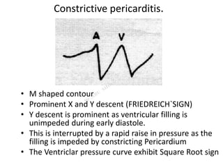 Constrictive pericarditis.
• M shaped contour
• Prominent X and Y descent (FRIEDREICH`SIGN)
• Y descent is prominent as ventricular filling is
unimpeded during early diastole.
• This is interrupted by a rapid raise in pressure as the
filling is impeded by constricting Pericardium
• The Ventriclar pressure curve exhibit Square Root sign
 
