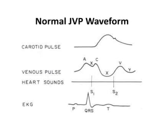 Normal JVP Waveform
 
