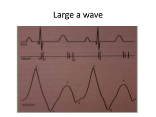 Large a wave
 