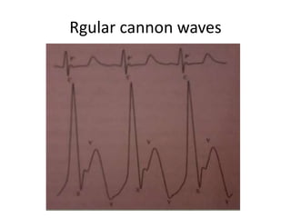 Rgular cannon waves
 