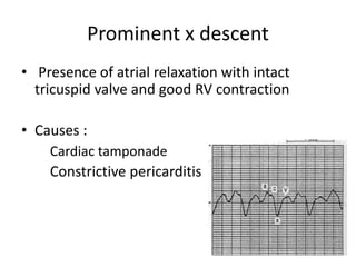 Prominent x descent
• Presence of atrial relaxation with intact
tricuspid valve and good RV contraction
• Causes :
Cardiac tamponade
Constrictive pericarditis
 