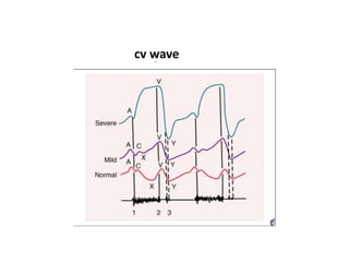 cv wave
 
