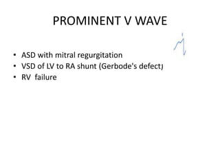 PROMINENT V WAVE
• ASD with mitral regurgitation
• VSD of LV to RA shunt (Gerbode's defect)
• RV failure
 
