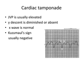 Cardiac tamponade
• JVP is usually elevated
• y descent is diminished or absent
• x wave is normal
• Kussmaul's sign
usually negative
 