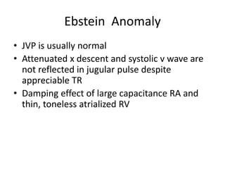 Ebstein Anomaly
• JVP is usually normal
• Attenuated x descent and systolic v wave are
not reflected in jugular pulse despite
appreciable TR
• Damping effect of large capacitance RA and
thin, toneless atrialized RV
 