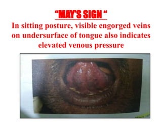 “MAY’S SIGN “
In sitting posture, visible engorged veins
on undersurface of tongue also indicates
elevated venous pressure
 