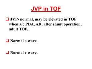 JVP in TOF
 JVP- normal, may be elevated in TOF
when a/c PDA, AR, after shunt operation,
adult TOF.
 Normal a wave.
 Normal v wave.
 