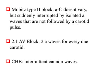  Mobitz type II block: a-C doesnt vary,
but suddenly interrupted by isolated a
waves that are not followed by a carotid
pulse.
 2:1 AV Block: 2 a waves for every one
carotid.
 CHB: intermittent cannon waves.
 