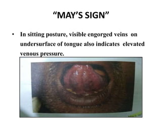 “MAY’S SIGN”
• In sitting posture, visible engorged veins on
undersurface of tongue also indicates elevated
venous pressure.
 
