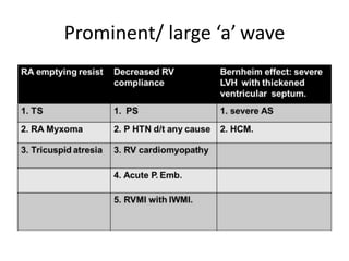 Prominent/ large ‘a’ wave
 