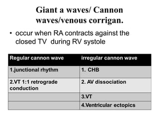 Giant a waves/ Cannon
waves/venous corrigan.
• occur when RA contracts against the
closed TV during RV systole
 
