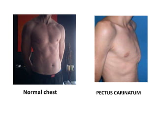 PECTUS CARINATUMNormal chest
 