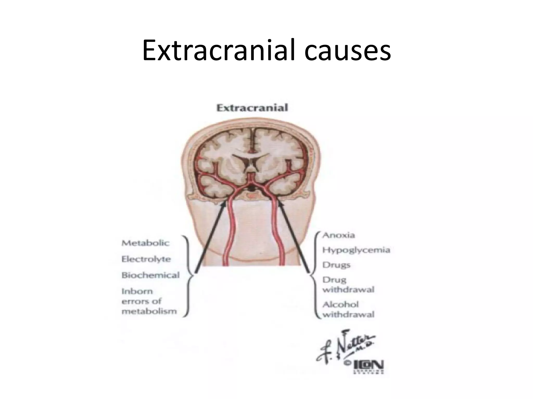 Extracranial causes
 