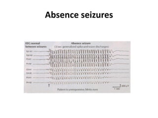 Absence seizures
 