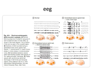 eeg
 