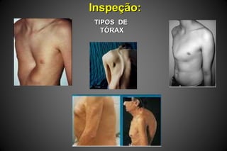 Inspeção:Inspeção:
TIPOS DETIPOS DE
TÓRAXTÓRAX
 