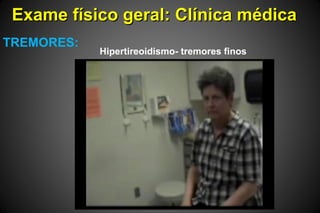 Exame físico geral: Clínica médicaExame físico geral: Clínica médica
TREMORES:
Hipertireoidismo- tremores finos
 