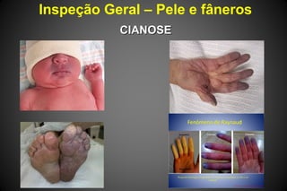 Inspeção Geral – Pele e fâneros
CIANOSECIANOSE
 