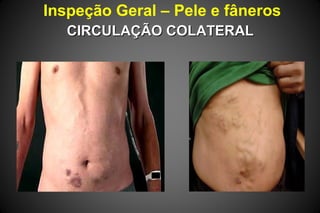 Inspeção Geral – Pele e fâneros
CIRCULAÇÃO COLATERALCIRCULAÇÃO COLATERAL
 