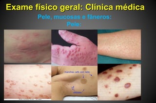 Exame físico geral: Clínica médicaExame físico geral: Clínica médica
Pele, mucosas e fâneros:
Pele:
 