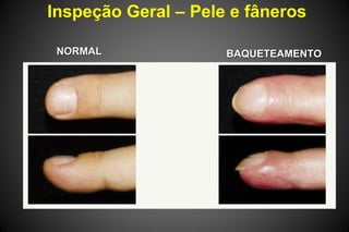 Inspeção Geral – Pele e fâneros
NORMALNORMAL BAQUETEAMENTOBAQUETEAMENTO
 