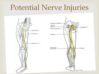 
Potential Nerve Injuries
 
