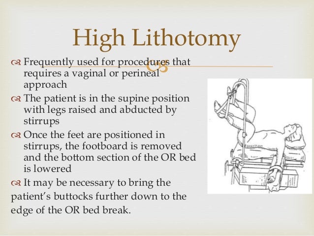 lithotomy
