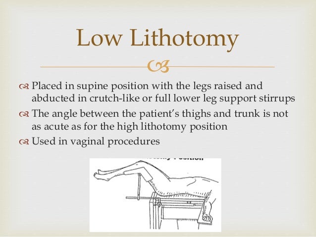 lithotomy