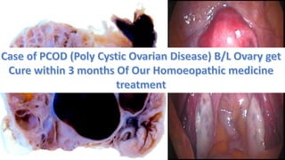  PCOD (Poly Cystic Ovarian Disease) B/L Ovary & Our Homoeopathic medicine treatment