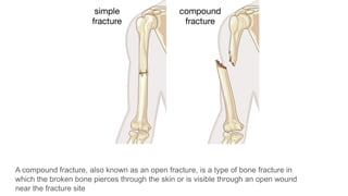 compound fractures in orthopaedics .pptx