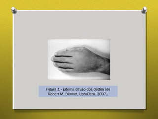 Figura 1 - Edema difuso dos dedos (de
Robert M. Bennet, UptoDate, 2007).
 
