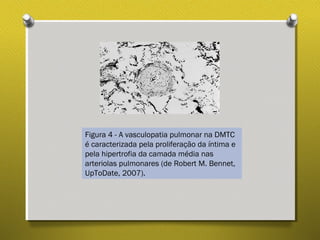 Figura 4 - A vasculopatia pulmonar na DMTC
é caracterizada pela proliferação da íntima e
pela hipertrofia da camada média nas
arteriolas pulmonares (de Robert M. Bennet,
UpToDate, 2007).
 