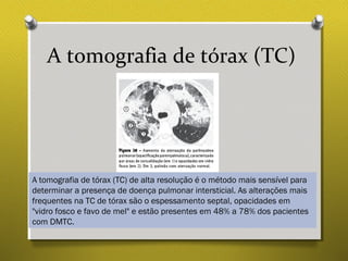 A tomografia de tórax (TC)
A tomografia de tórax (TC) de alta resolução é o método mais sensível para
determinar a presença de doença pulmonar intersticial. As alterações mais
frequentes na TC de tórax são o espessamento septal, opacidades em
"vidro fosco e favo de mel" e estão presentes em 48% a 78% dos pacientes
com DMTC.
 