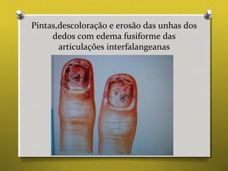 Pintas,descoloração e erosão das unhas dos
dedos com edema fusiforme das
articulações interfalangeanas
 
