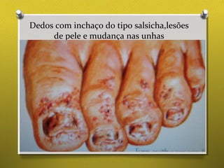Dedos com inchaço do tipo salsicha,lesões
de pele e mudança nas unhas
 