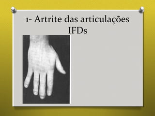 1- Artrite das articulações
IFDs
 