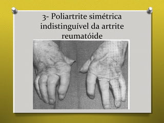 3- Poliartrite simétrica
indistinguível da artrite
reumatóide
 