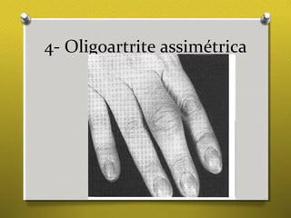 4- Oligoartrite assimétrica
 