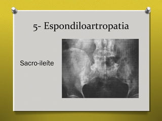 5- Espondiloartropatia
Sacro-ileíte
 