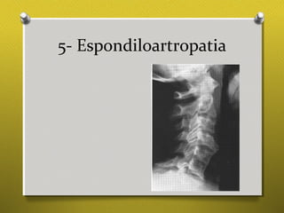 5- Espondiloartropatia
 