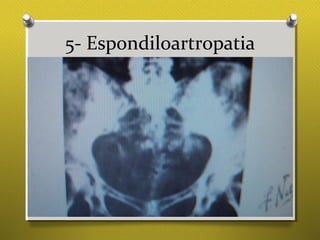 5- Espondiloartropatia
 